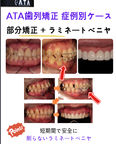 ワンデーラミネートの前に部分矯正を検討するとは？。