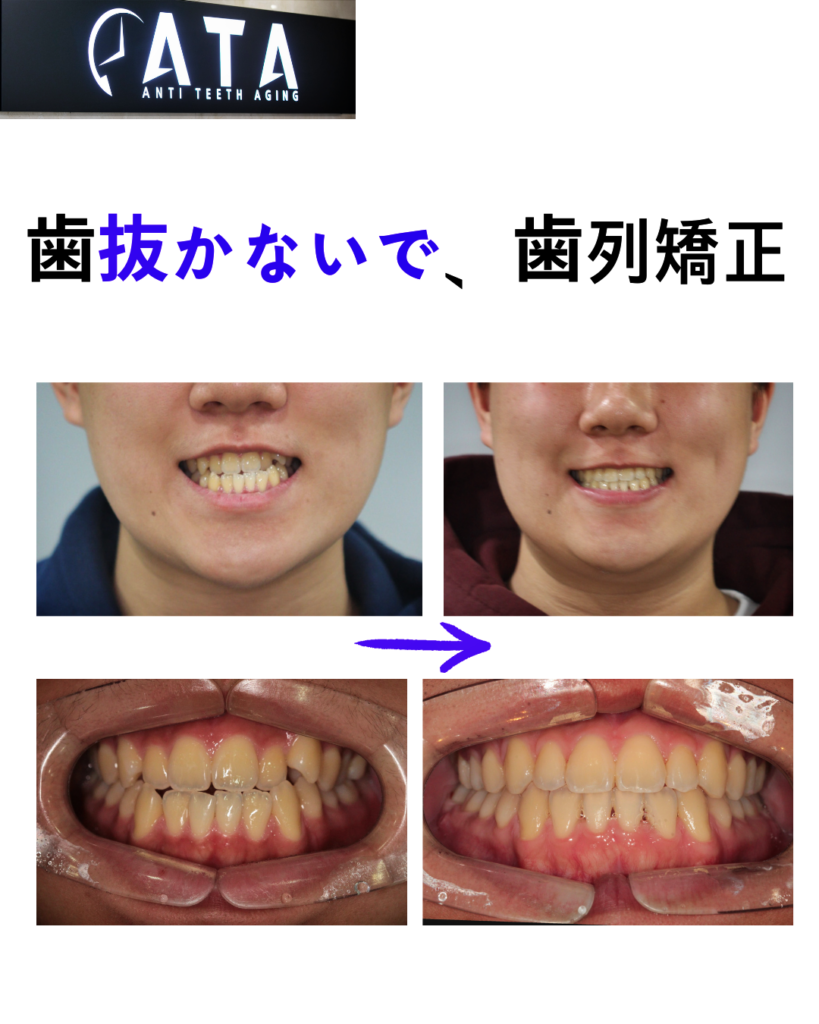 非抜歯矯正
