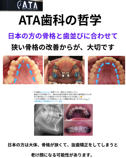 顎や歯列が狭い症例では、限られたスペースに無理やり歯を並べるのではなく、必要に応じて歯列の幅を改善する治療を検討します。
骨格や年齢、歯の状態を確認し、MARPEなどの拡大装置を使用する場合もあります。
歯を並べるためのスペースを確保することで、抜歯を避けられる可能性や、より自然な歯列を目指せる可能性があります。