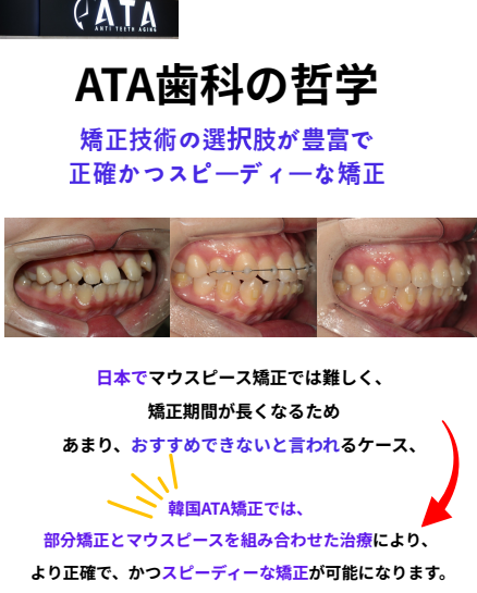 ATA歯科では、ワイヤー矯正、マウスピース矯正、部分矯正、拡大装置など、さまざまな治療方法から患者様に適した方法を選択します。
症例によっては、マウスピース矯正だけでは歯の移動が難しかったり、治療期間が長くなったりすることがあります。
その場合は、部分矯正とマウスピース矯正を組み合わせるなど、それぞれの長所を活かした治療計画をご提案します。