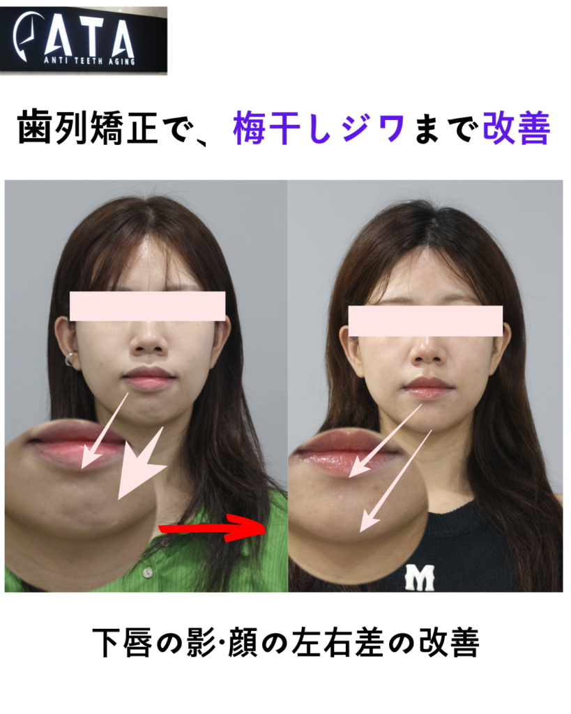韓国でガミースマイル矯正｜抜歯せずに改善できる？ソウル江南ATA歯科